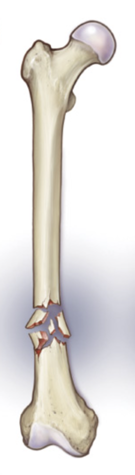 <ul><li><p>Bone breaks into <strong>3 or more pieces</strong></p></li><li><p>Pieces are <strong>misaligned</strong></p></li></ul><p></p>