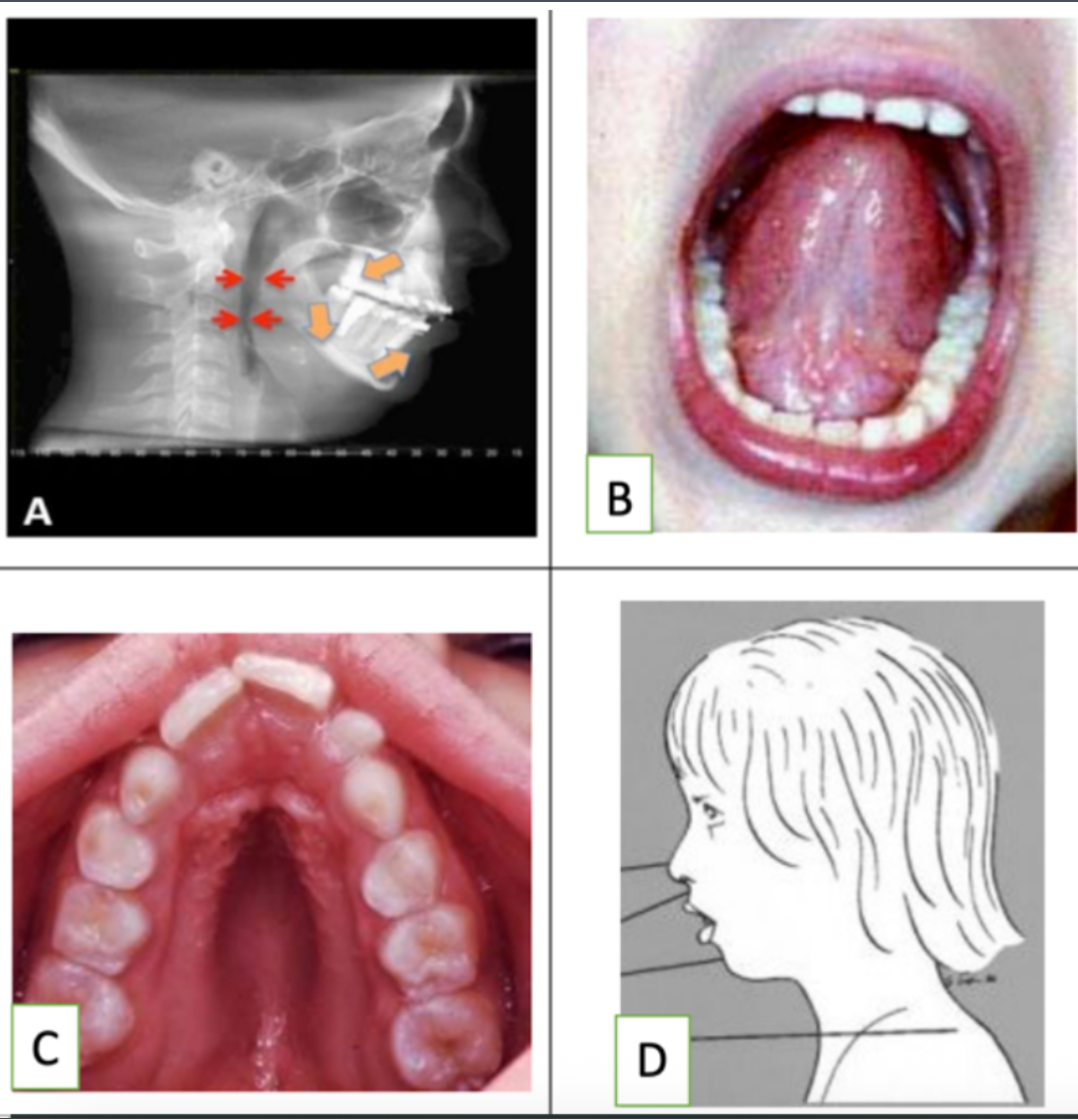 <p>Looking at the pictures: which of the pictures show no evidence of orofacial myofunctional disorder?</p>