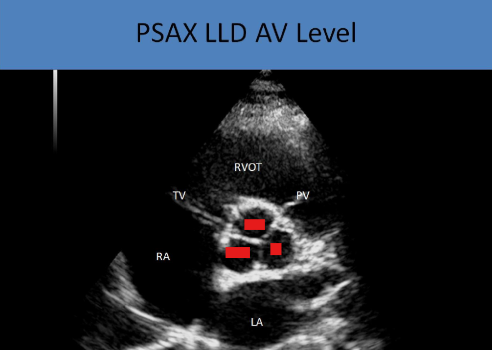<p>identify the cusps of the av</p>