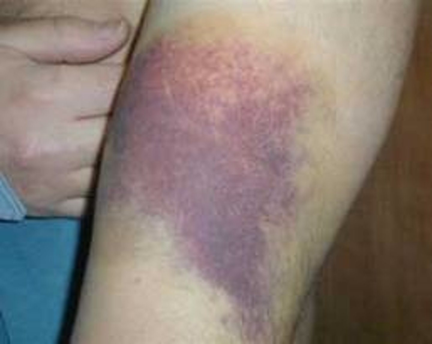 <p>1st step in healing a broken bone: an elevated, localized collection of blood trapped under the skin that usually results from trauma</p>