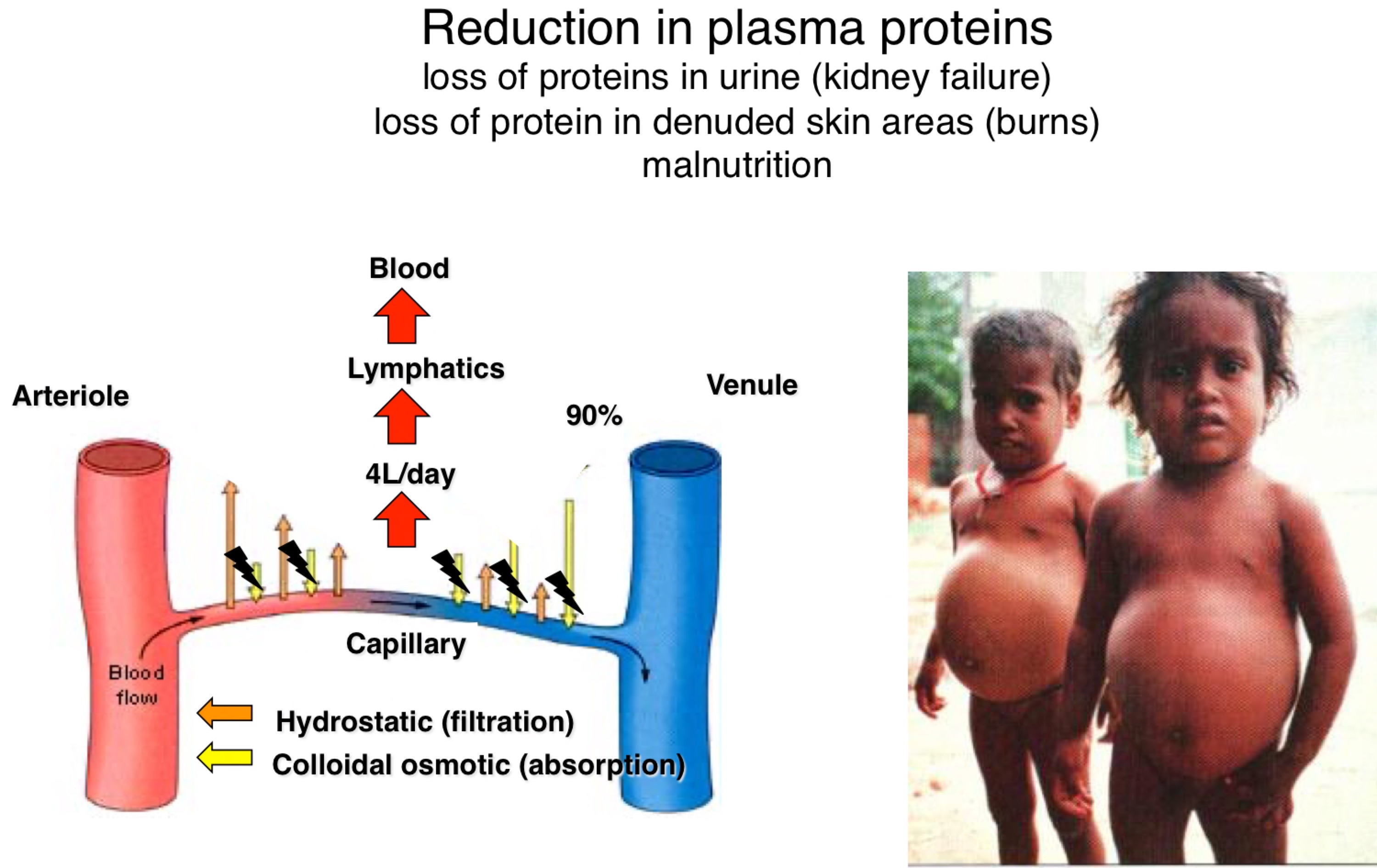 → Dop of protein in blood proteins

→ Kidney problem lose lots of proteins

→ Burns 

→ Malnutrition (not enough protein consumed)