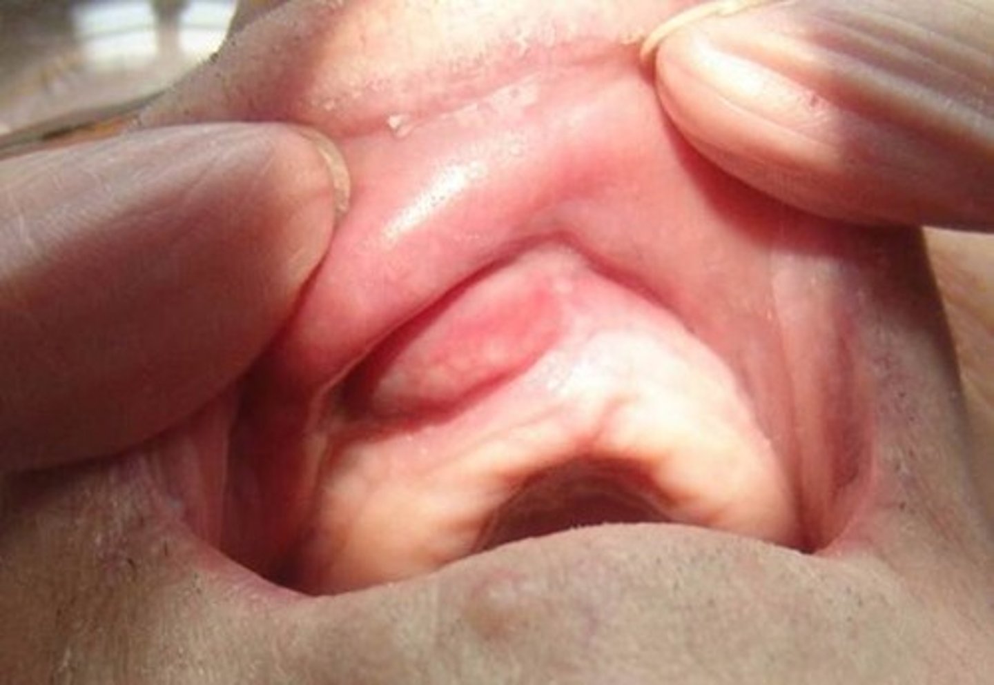 <p>soft swelling in vestibule</p><p>• lateral to midline; Maxillary canine area</p><p>• population: middle-aged females</p>