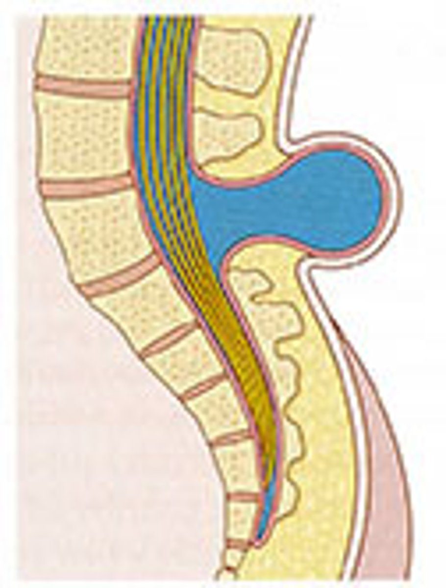 <p>Type of spina bifida cystica; hernial protrusion of saclike cyst of meninges filled with spinal fluid</p>