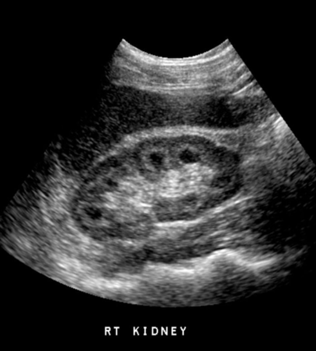 <p>medullary sponge kidney (MSK)</p>