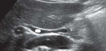 <p>What is the crossed out portion if the ‘P’ stands for pancreas?</p>