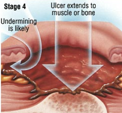 <ul><li><p>Damage to epidermis, dermis, subcutaneous fat ± <strong>muscle/bone </strong></p></li><li><p>Pain &amp; bleeding</p></li><li><p>May be insensate</p></li></ul>