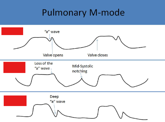 <p>pulmonic valve m mode</p>