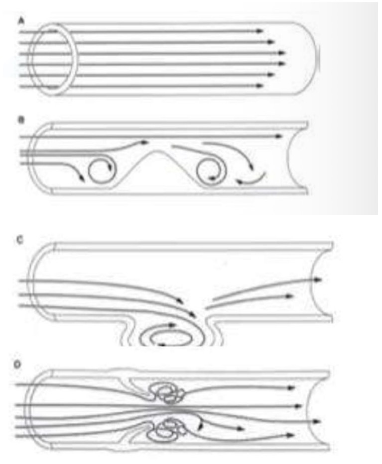 <p>• <strong>Flusso Laminare:</strong> Fisiologico (Quadro A).</p><p>• <strong>Flusso Vorticoso/Turbolento:</strong></p><p>• Si crea in caso di ostruzione (Quadro B), ipertensione, o biforcazioni.</p><p>• Il vortice danneggia l'endotelio, riduce l'apporto di ossigeno e può rimuovere le cellule endoteliali stesse.</p><p>• <strong>Biforcazioni:</strong> La somma dei calibri dei vasi figli è maggiore del vaso origine -> la velocità si riduce -> formazione di vortici -> danno endoteliale (comune sede di placche/trombi).</p><p>• Sacca aneurismatica (quadro C)</p><p>• <strong>Valvole Venose:</strong> A livello delle tasche valvolari il flusso ristagna e crea vortici (Quadro D), sede tipica di inizio dei trombi venosi.</p>