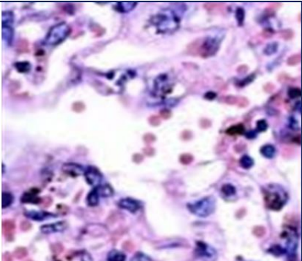<p>hemorrhage type</p>
