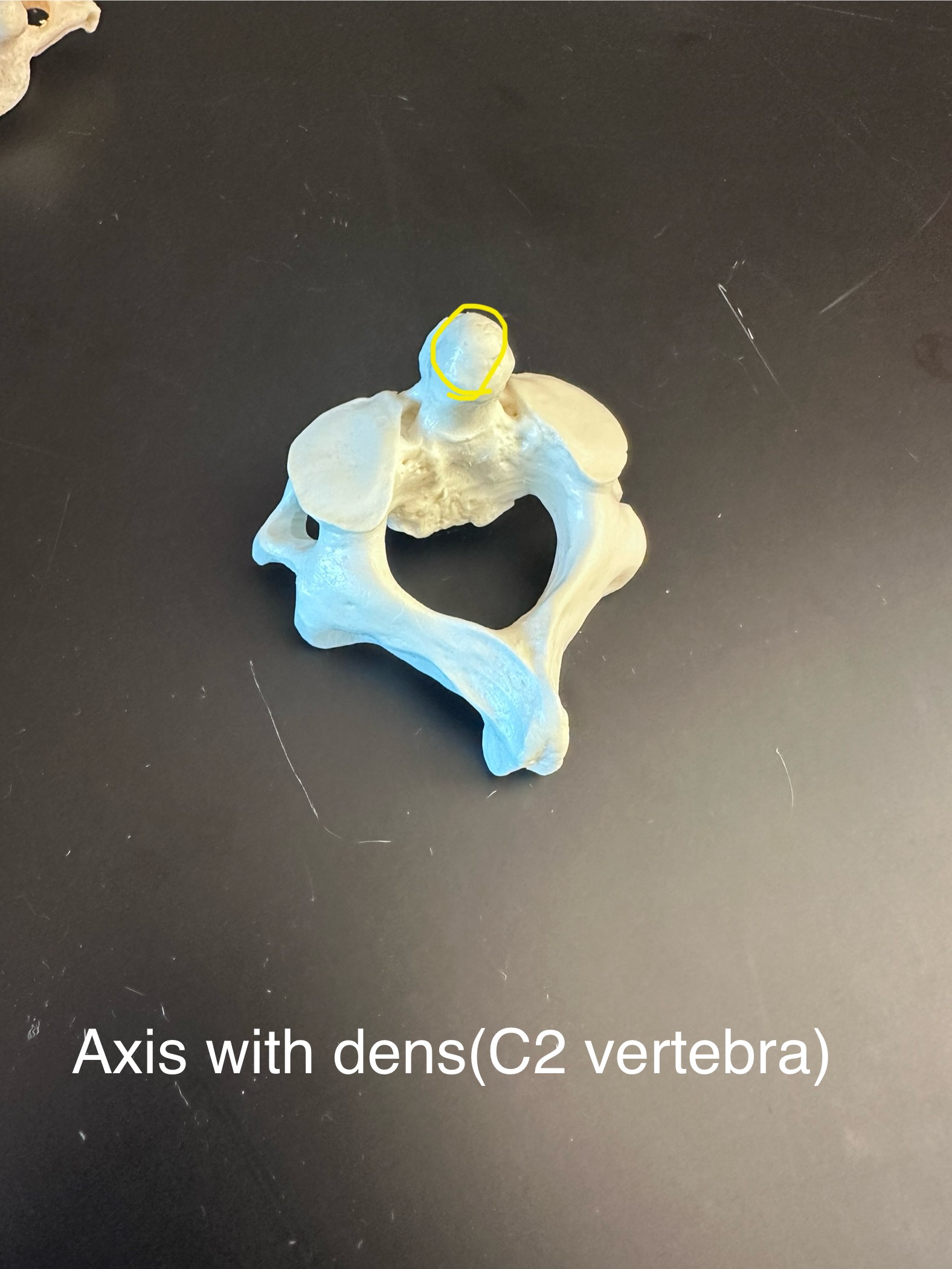 <p>Axis with Dens (C2 vertebra)</p>