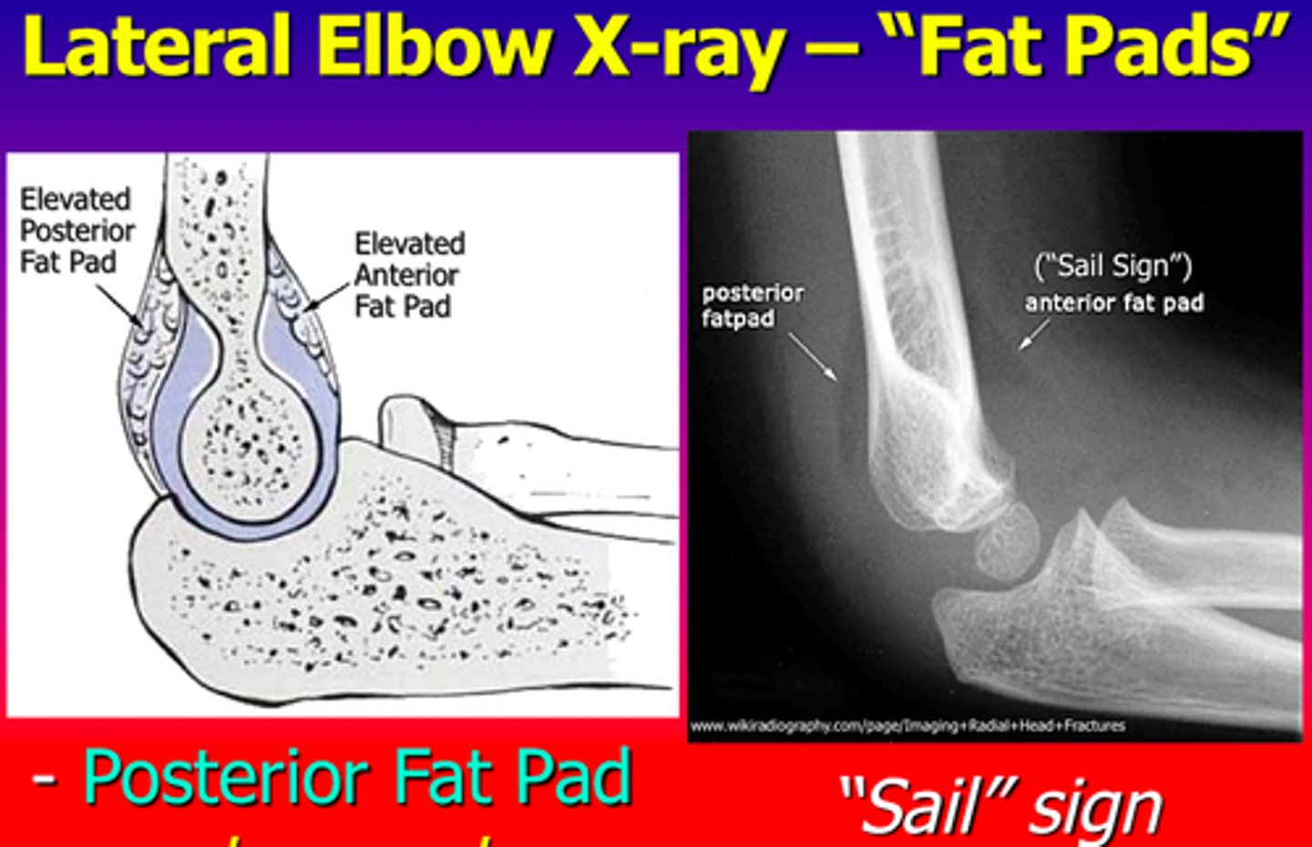 <p>It is blood in the joint indicating a fracture even if the fracture line cannot be seen.</p>