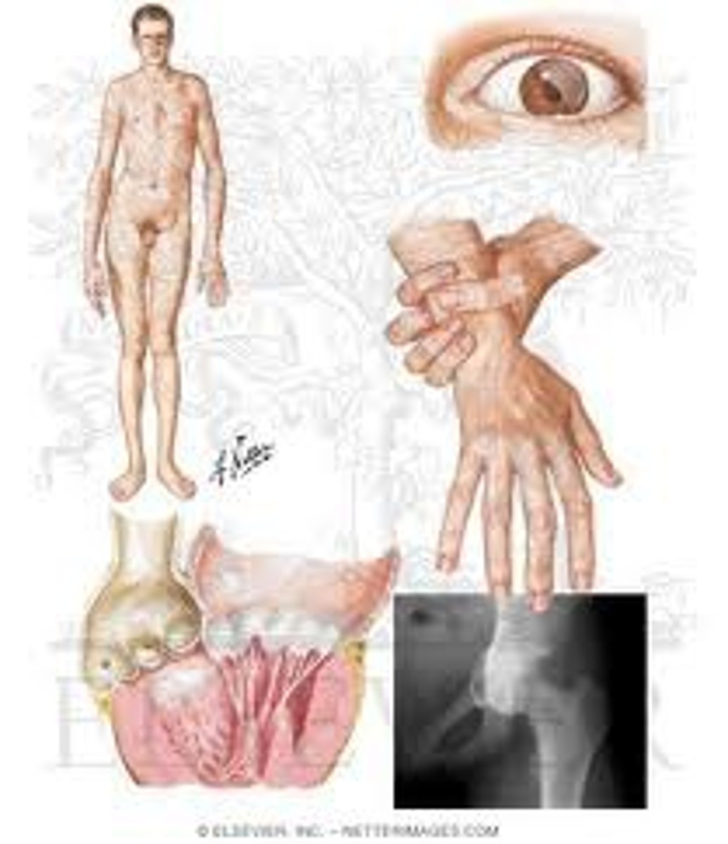 <p>Marfan Syndrome (fibrillin defect)</p><p>AD</p>