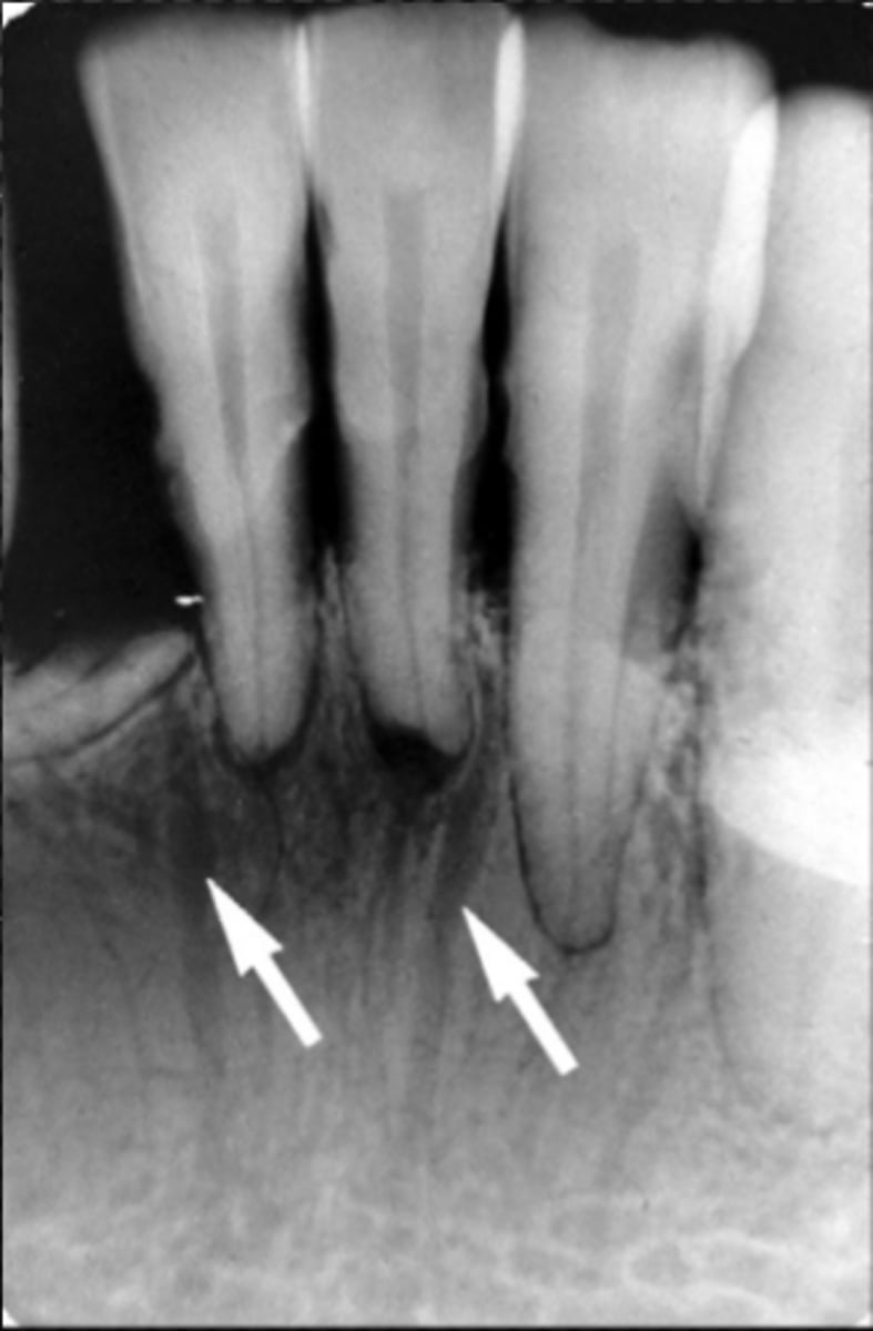 <p>Identify the radiolucent structure</p>