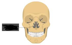 <p>bony marking?</p>