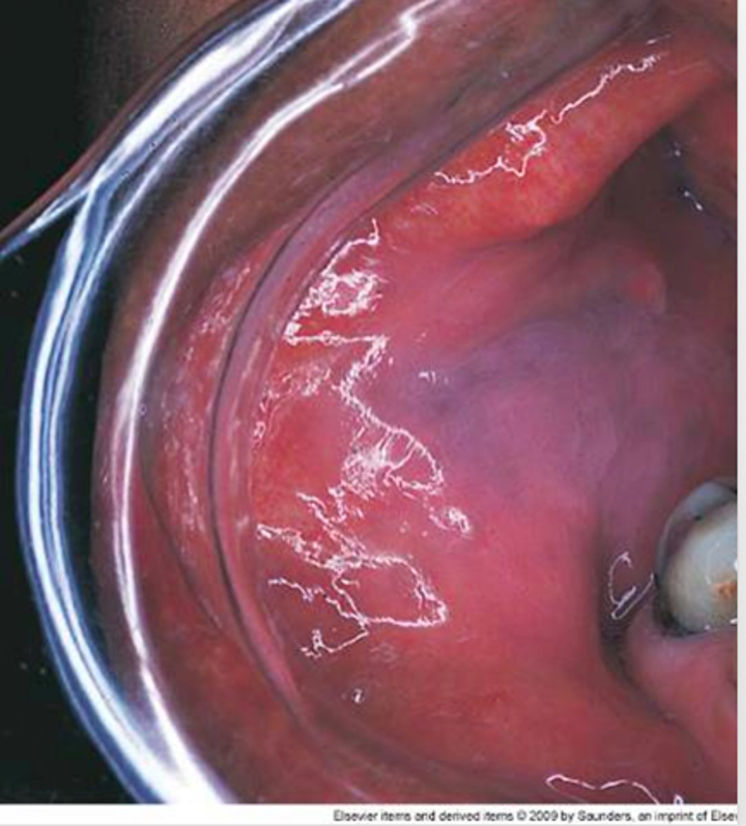 <p>leukoedema.</p><p>Leukoedema is a diffuse opalescence most commonly seen on the buccal mucosa in black individuals. </p><p>Linea alba is a “white line” that extends anteroposteriorly on the buccal mucosa along the occlusal plane. It is most prominent in patients who have a clenching or grinding habit. </p><p>Leukoplakia is a clinical term for a white lesion, the cause of which is unknown. </p><p>White sponge nevus is a genetic (autosomal dominant) trait. Clinically, it is characterized by a soft white, folded (or corrugated) oral mucosa. A thick layer of keratin produces the whitening.</p>