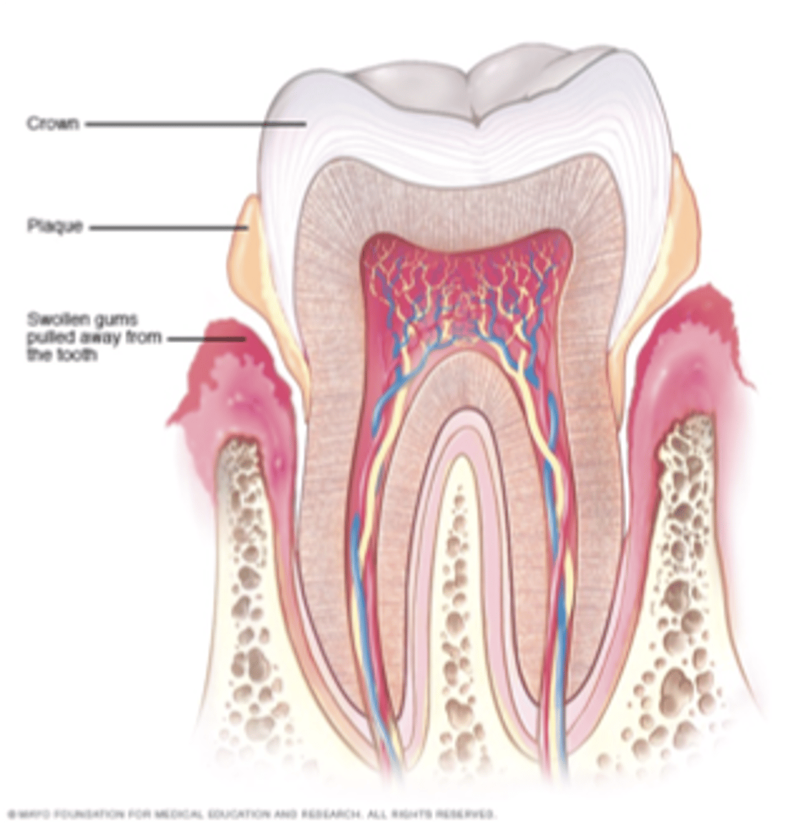 <p>Periodontitis disease treatment</p>