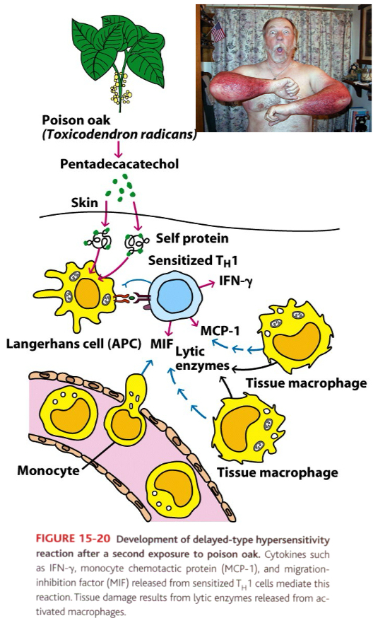 <p>Small molecule (haptens) can complex with skin proteins (carriers) and are internalized by antigen presenting cells in skin (Langerhan’s cells) which the induce Th1 response.</p><p>Example: poison oak leaves contain pentadecacatechol (hapten) forms a complex with skin proteins and induce Th1 response (sensitization phase).</p><p>After 48-72 hours after the second exposure, the secreted cytokines cause macrophages to accumulate at the site.</p>