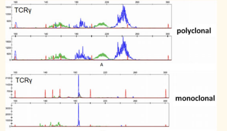 <p>decided reactive/ neoplastic; detect clonalituy</p><p></p><p>PCR for Antigen Receptor Rearrangements (PARR) • Specialised PCR which amplifies either – Immunoglobulin gene (from B cells) or – T cell receptor gene (from T cells) • Assessment of clonality – Neoplastic populations are monoclonal – Most reactive populations are polyclonal</p><p></p><p>Differentiating reactive and neoplastic disease • Small clonal population (so not obvious on routine cytology/histopathology or sometimes on flow) • Not a stand alone test – should be interpreted with the other diagnostic tests • Specificity is generally very high, sensitivity less so • A negative PARR result DOES NOT rule out lymphoma – &gt;75% of confirmed canine lymphoma positive – 65% of confirmed feline lymphoma positive • PARR can contribute to diagnosis of both canine and feline IBD – Especially small cell lymphomas – Value is in high specificity but has relatively low sensitivity</p>