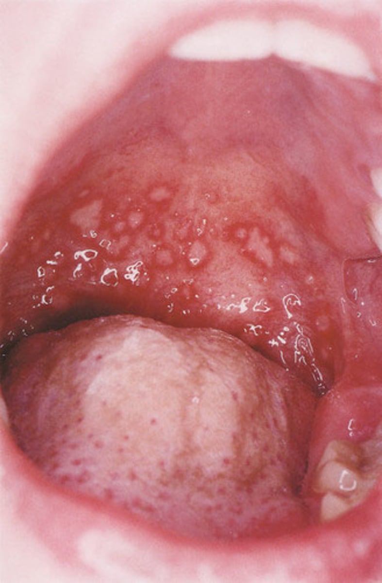 <p>Vesicles or ulcers of posterior oral cavity or soft palate</p><p>Flu-like symptoms</p>