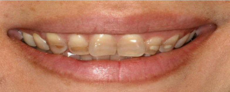 <p>(135) Stained Teeth</p>