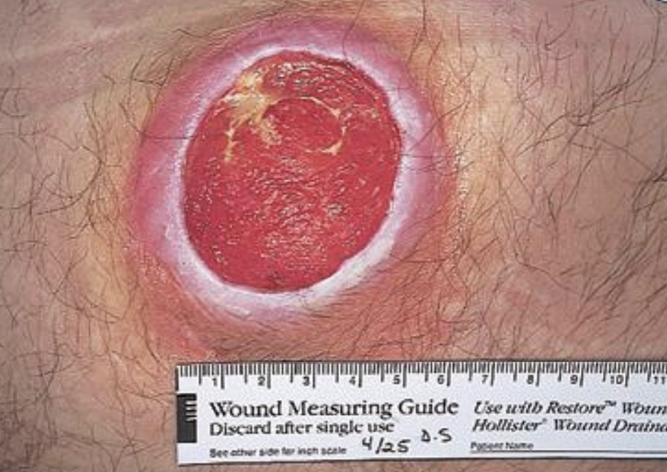 <p>pressure injury stage</p>