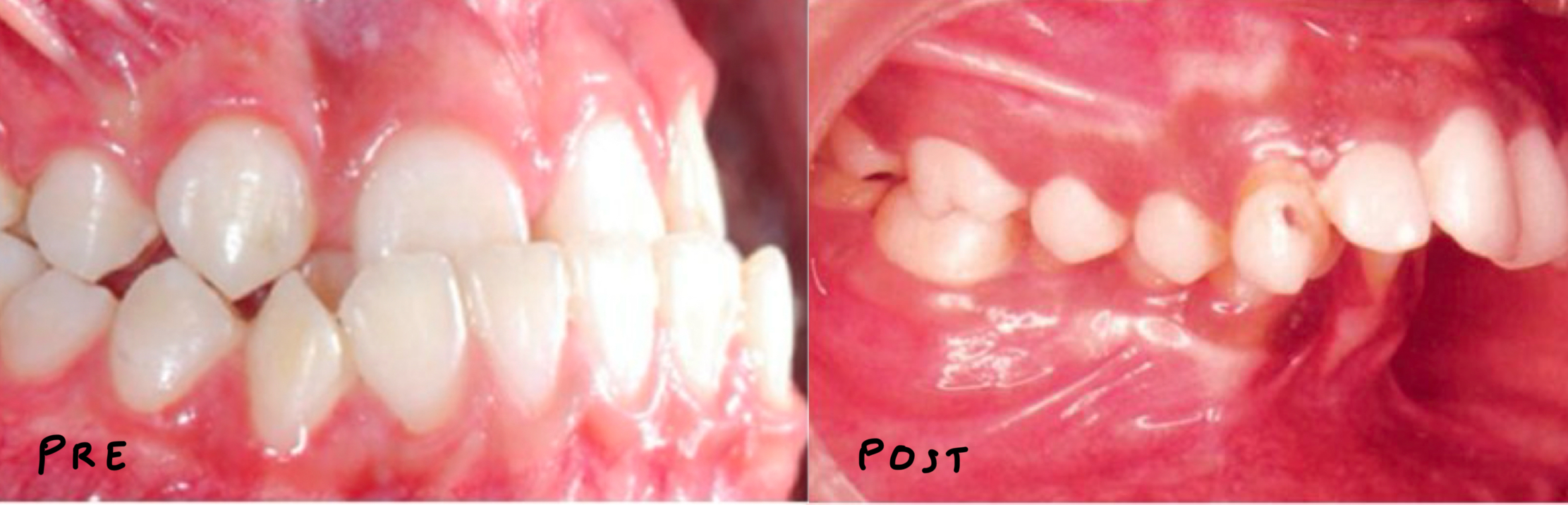 <p>Mandible more anterior in centric occlusion vs more posterior</p><p>(Maxilla in fixed position)</p>