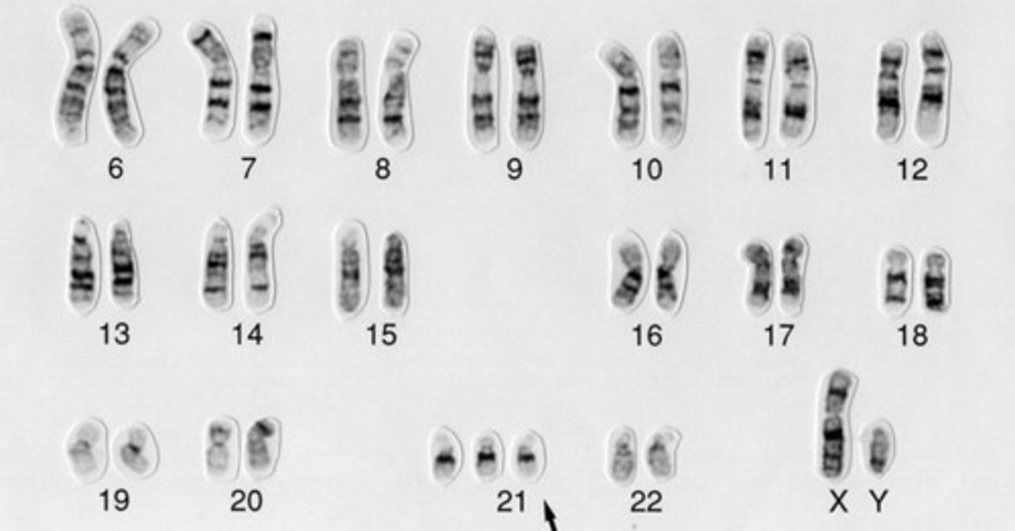 <p>condition in which an individual has three number 21 chromosomes, resulting in Down syndrome</p>