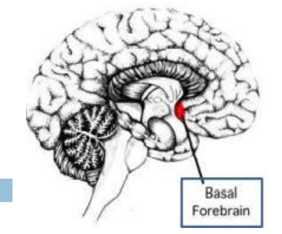 production de souvenirs fabriqués, déformés, ou mal interprétés, sur soi-même ou le monde sans l’intention consciente de tromper. = Le patient se fait de fausses réalités et y croit. Il s’agit souvent de lésions du cerveau antérieur et basal (plus souvent à droite qu’à gauche).
• Rupture d’anévrisme AcoA.
• Syndrome de Korsakoff.
• Maladie d’Alzheimer.
Les théories explicatives sont nombreuses :
✓ Trouble du rappel en mémoire (reality monitoring/source monitoring).
✓ Aide à maintenir le « self » chez un patient amnésique (remplir les « trous »).
✓ Evocation consciente dans un cadre délirant ; biais pour accepter un souvenir s’il est en accord avec nos croyances.