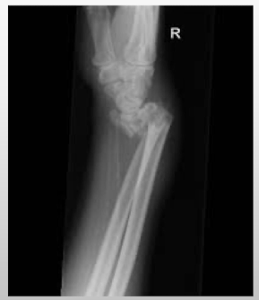 <p>FOOSH with a FLEXED wrist</p><p>- wrist will be displaced anteriorly/towards flexed surface</p>
