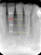 <p>blunting of alveolar crests and slight loss of height </p>