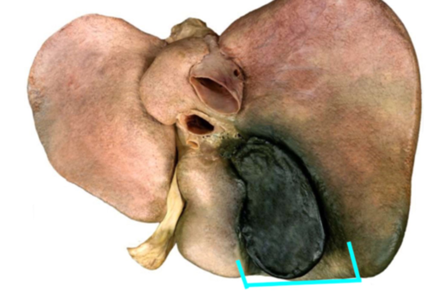 <p>Depression</p><p>bottom right of the H</p>