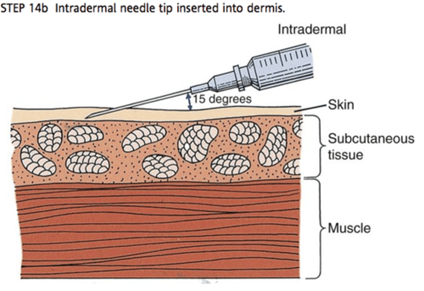 <p>intradermal</p>