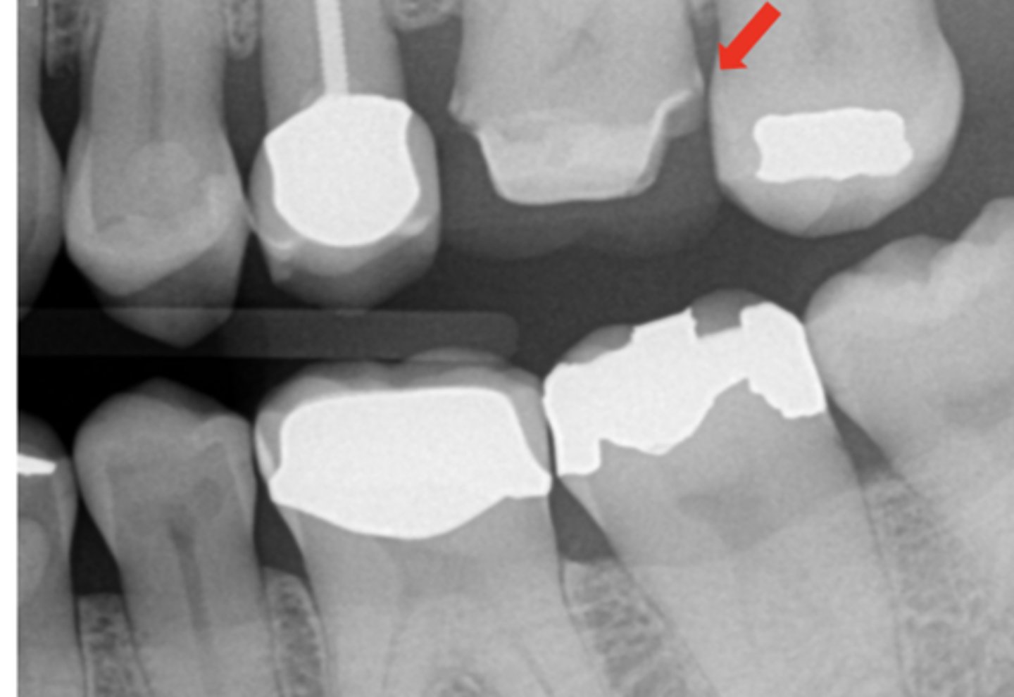 <p>What is the issue with the distal of #14?</p>