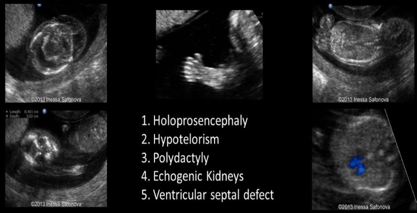 <p>holoprosencephaly is commonly assoc w</p><p>a) noonan</p><p>b) trisomy 13 </p><p>c) turner</p><p>d) trisomy 21</p>