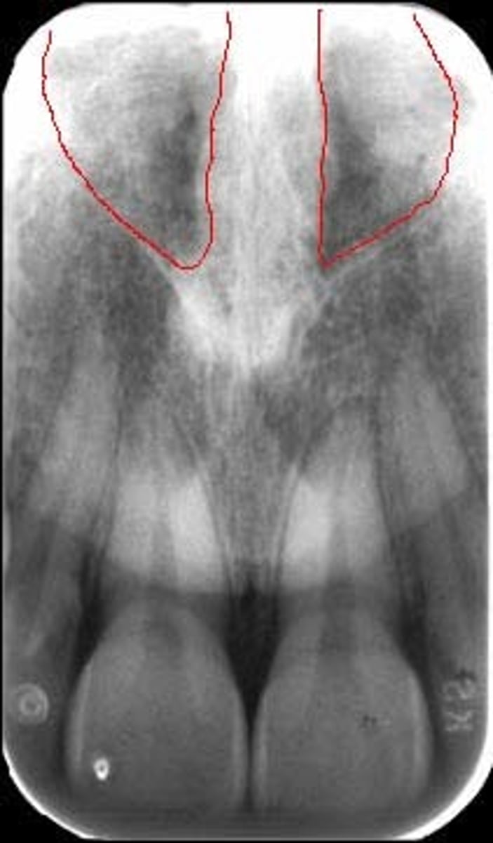 <p>2 radiolucent areas in upper portion of radiograph; air spaces</p>