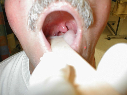 <p>sagging of pharyngeal muscles on one side, uvula deviated to contralateral side, partial vocal muscle paralysis</p>