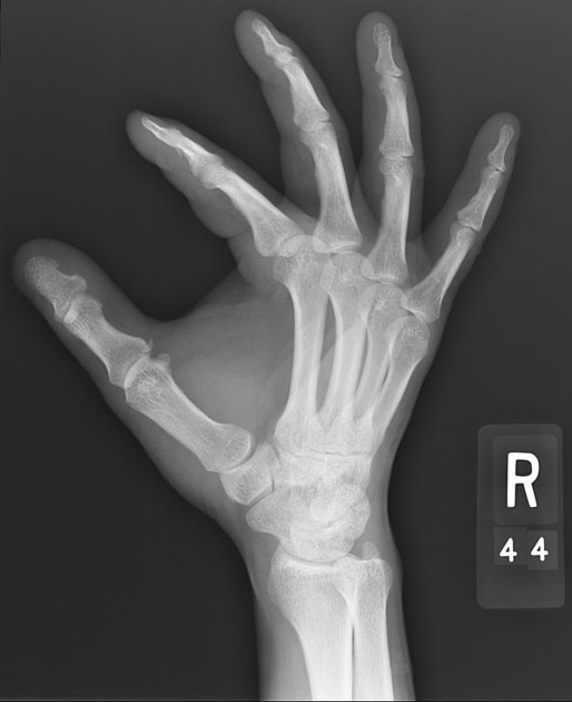 <p>Describe the abnormality demonstrated. </p>
