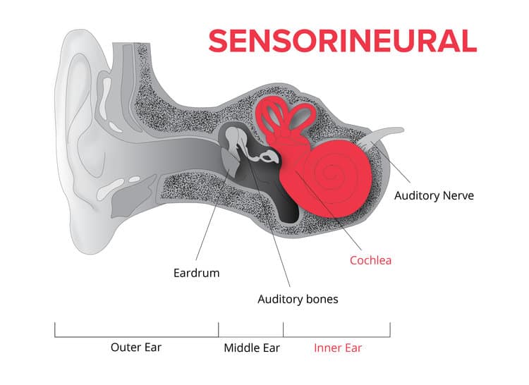 <p>a type of hearing loss that affects the inner ear and the nerve that carries sound signals to the brain</p>