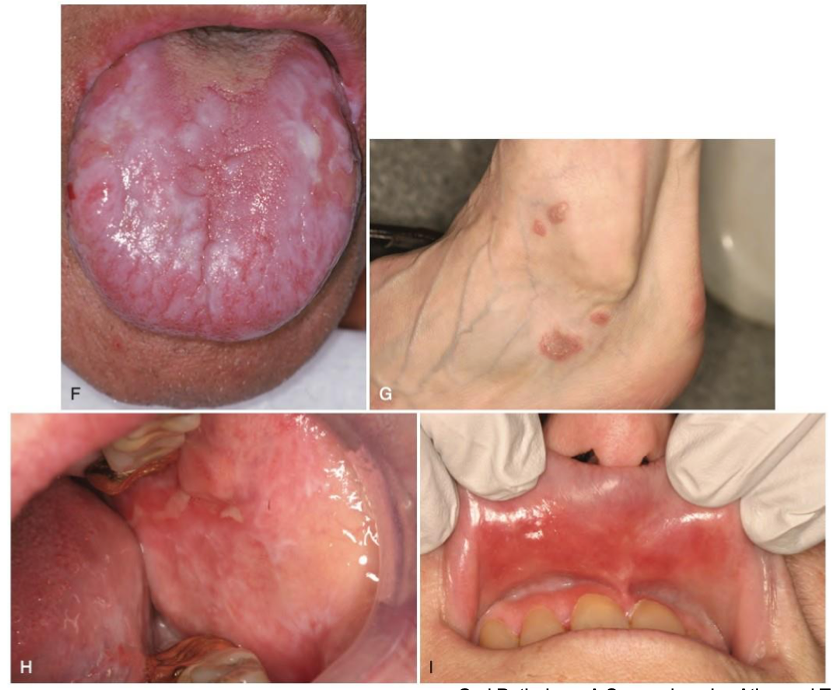 <p>which autoimmune/immune-mediated/allergic lesion:</p>