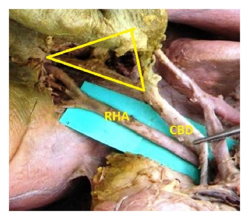 <p>The artery that supplies oxygenated blood to the liver, gallbladder, and part of the stomach</p><p>Shredded, torn</p>