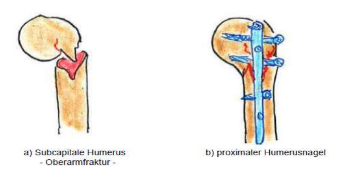 <p>Oberarmbruch - Subcapital</p><ul><li><p>Nagel soll Position fixieren und Knochen zum heilen bringen</p></li></ul><p></p>