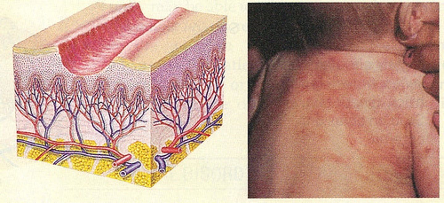 <p>linear or punctate erosions caused by scratching</p>