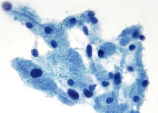 <p>• Granular cell tumor (lysosomes) </p><p>• Acinar cell carcinoma (zymogens) </p><p>• Oncocytic/Hürthle cell neoplasms (mitochondria) </p><p>• Neuroendocrine tumors (neurosecretory granules) •</p><p> Hepatocytes/tumors </p><p>• Melanoma (melanosomes) </p><p>• Adrenal cortical/tumors </p><p>• Leydig cells/tumors</p>