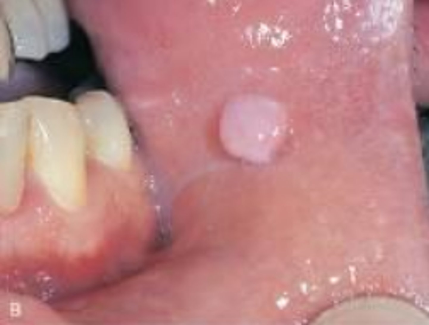 <p>The most common tumor of the oral cavity</p><p>Caused by chronic trauma</p><p>Pink, smooth firm</p><p>Usually painless</p><p>Hyperplastic tissue in response to irritation</p>