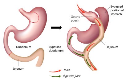<p>Which type of gastric bypass is shown?</p>