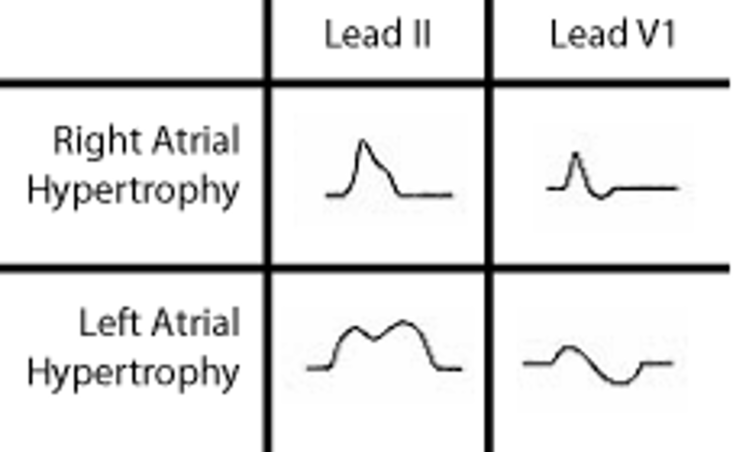 <p>Lead V1</p><p>Right hypertrophy: initial portion of diphasic p wave is larger</p><p>Left hypertrophy: terminal portion of diphasic p wave is larger</p>