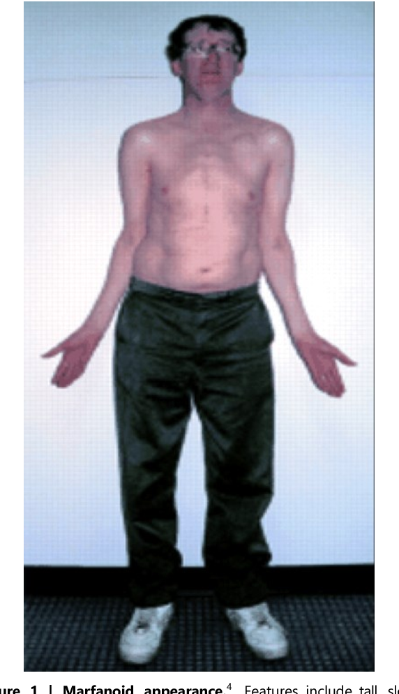 <ul><li><p><strong>Males</strong>: has extra X chromosome (XXY)</p><ol><li><p><span style="color: rgb(240, 79, 79);"><strong>infertile</strong></span></p></li><li><p><span style="color: rgb(182, 147, 28);"><strong>low testosterone</strong></span></p></li><li><p><span style="color: rgb(124, 148, 28);"><strong>long limbs</strong></span></p></li><li><p><span style="color: rgb(39, 173, 39);"><strong>increased height</strong></span></p></li><li><p><span style="color: rgb(22, 188, 195);"><strong>small balls</strong></span></p></li><li><p><span style="color: rgb(71, 79, 210);"><strong>delayed puberty</strong></span></p></li><li><p>increased risk for <span style="color: rgb(238, 89, 254);"><strong>breast cancer</strong></span></p></li><li><p><span style="color: rgb(244, 49, 154);"><strong>female hair distribution</strong></span></p></li></ol></li></ul><p></p>