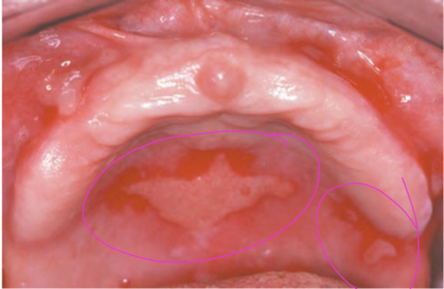 <p>Hint: in this disease antibodies are directed against components of the basement membrane</p>