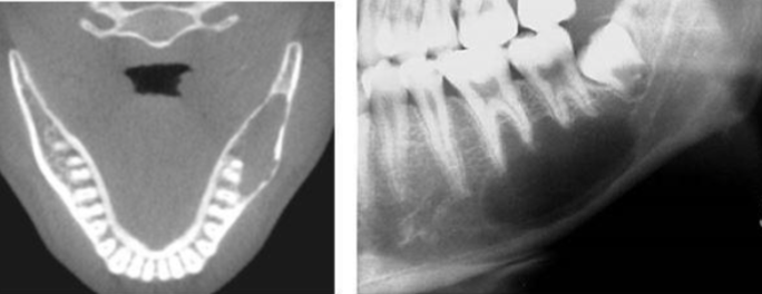 <p>well-defined<strong>, THINLY corticated,</strong> uniform radiolucent lesion, <strong>scalloping around roots</strong>,<strong> NO ROOT RESORPTION</strong> or displacement. this is probably a:</p>