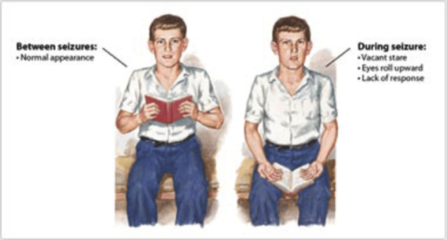 <p>Also called absence attack. A seizure that is characterized a loss of awareness and inability to recall events surrounding the seizure. The seizure does not include convulsing</p>